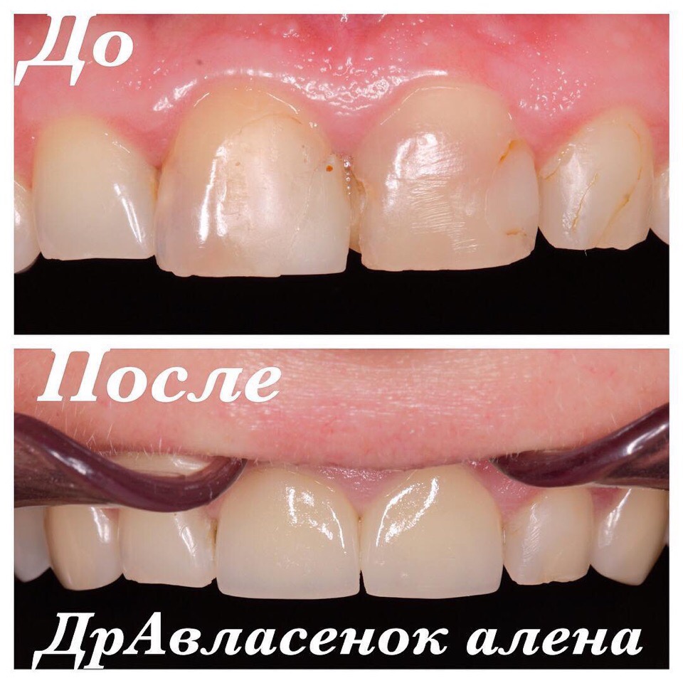 Керамические виниры