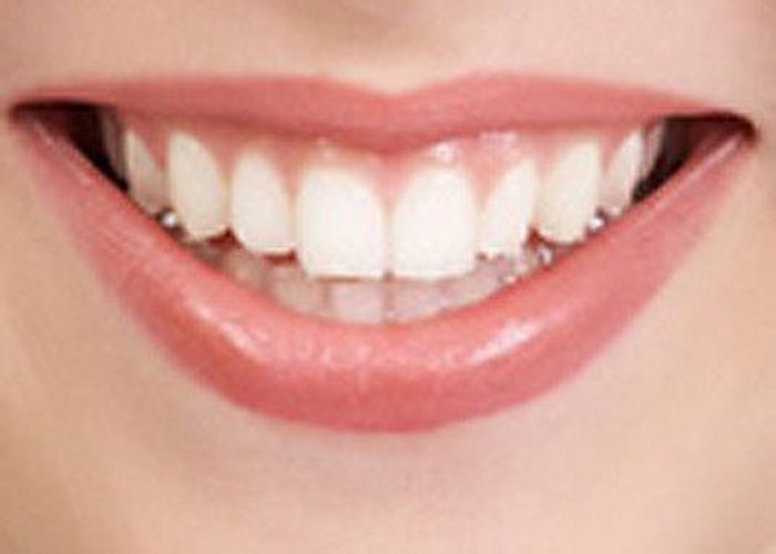 красивые зубы